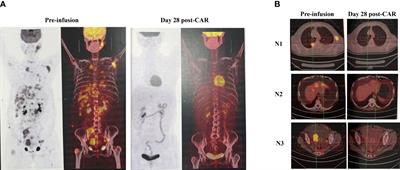 Rapid response in relapsed follicular lymphoma with massive chylous ascites to anti-CD19 CAR T therapy using Piggy Bac: A case report